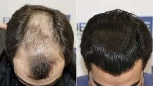 زراعة الشعر في الرياض والمملكة العربية السعودية