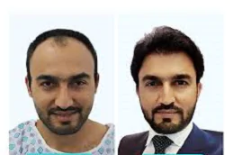 زراعة الشعر في الرياض 