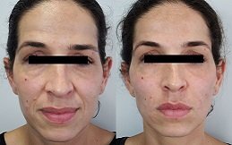 Best Dermal Fillers in Riyadh