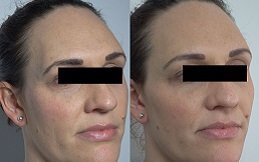 Dermal Fillers in Riyadh