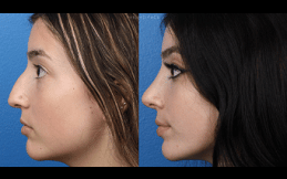 Rhinoplasty Clinic in Riyadh