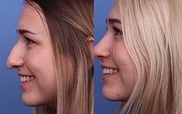 Rhinoplasty cost in riyadh