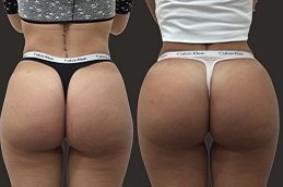 Best Butt Fillers Clinic in Riyadh