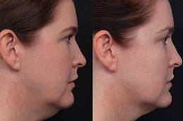 Best Double Chin Removal in riyadh