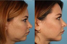 Double Chin Removal cost in riyadh