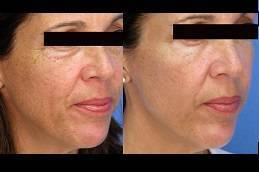 Laser Treatment in riyadh