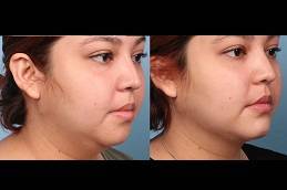 Best Double Chin Removal clinic in riyadh