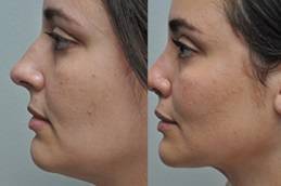 Best Double Chin Removal cost in Riyadh