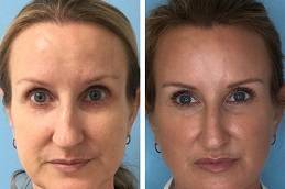 Best Liquid Facelift in riyadh