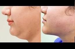 Double Chin Removal in riyadh