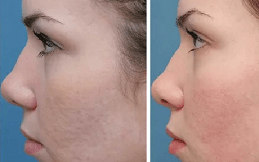 laser treatment in riyadhh