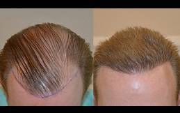 Best Hair Transplant Cost Clinic in Riyadh