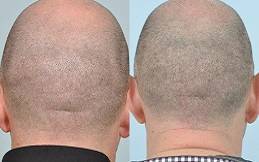 Best Hair Transplant Cost in Riyadh