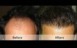 Best Hair Transplant Cost in Riyadh