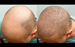 Hair Transplant Cost in Riyadh