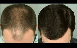 Hair Transplant Cost in Riyadh